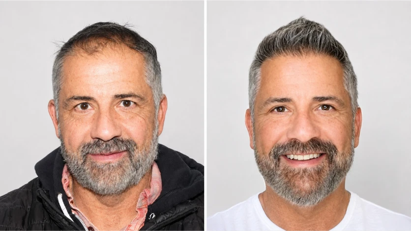 Antonio Posa, before and after hair transplant.