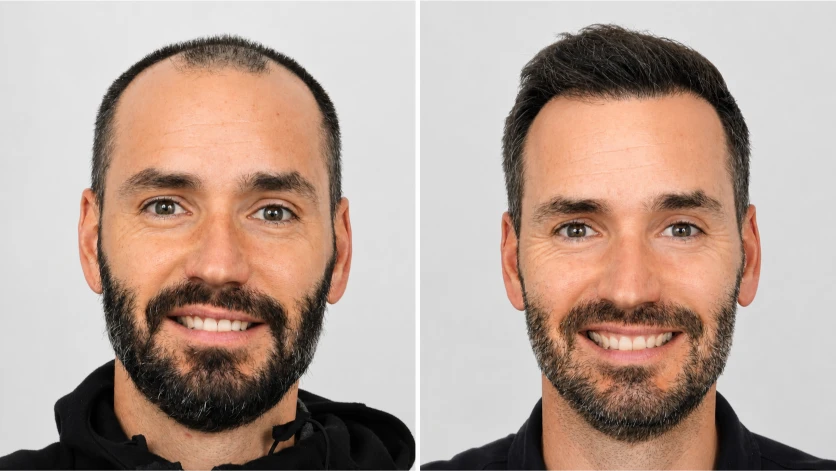 Chris Siegfried, before and after hair transplant.