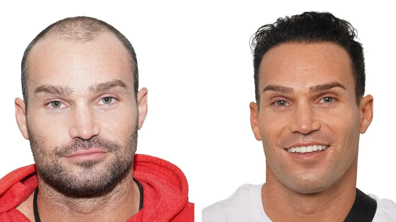 Dakota, before and after hair transplant. Advanced FUE, 1 procedure, 3,617 grafts.