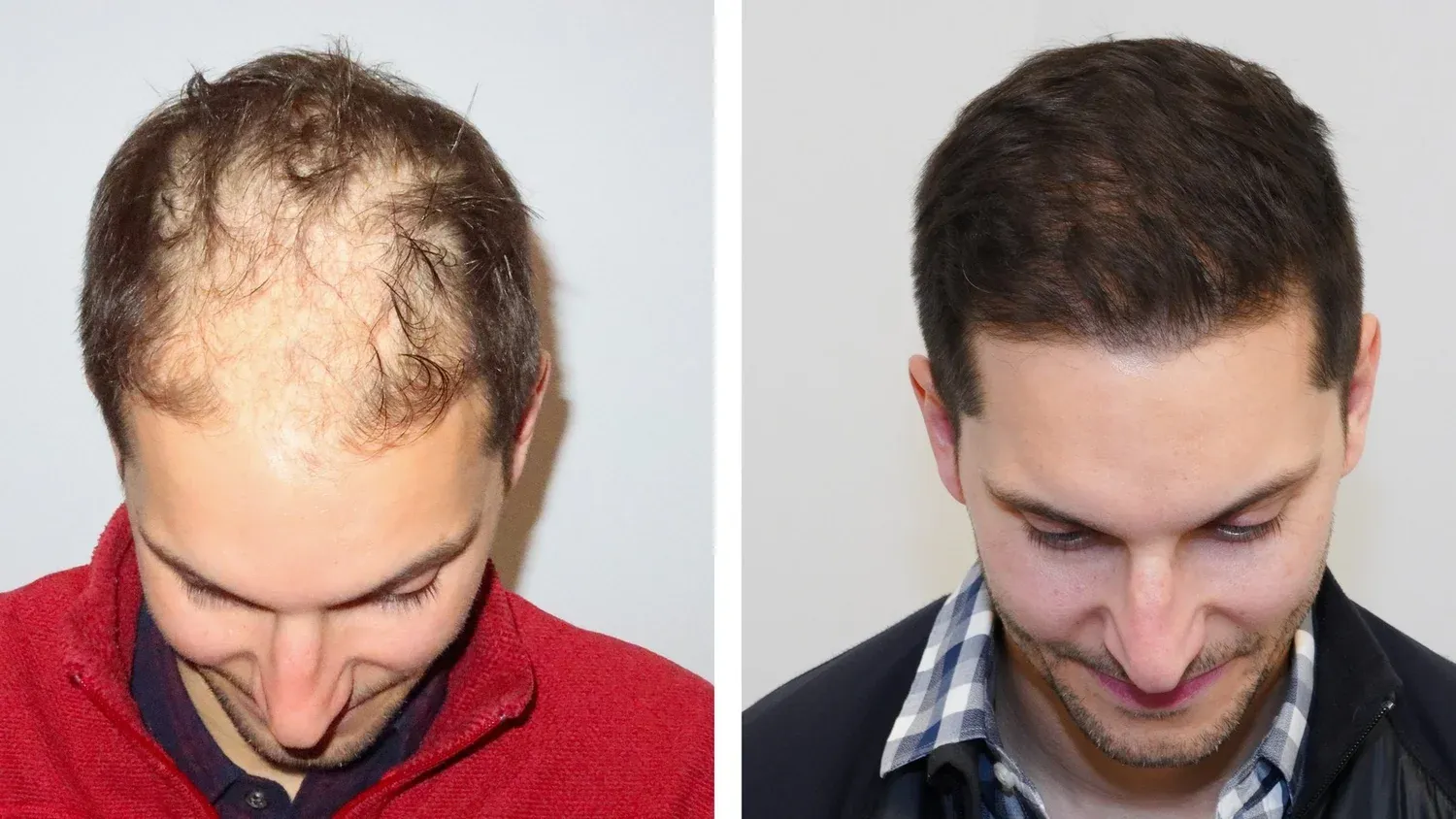 Nick, before and after hair transplant. Advanced FUE, 1 procedure, 2,865 grafts.