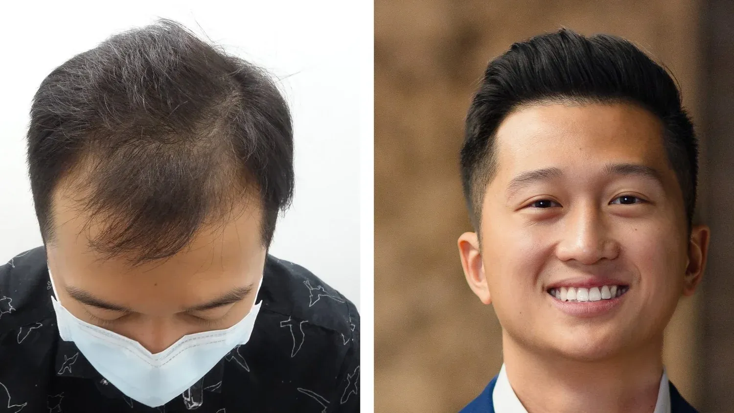 Timmy, before and after hair transplant. Advanced FUE, 1 procedure, 2,505 grafts.