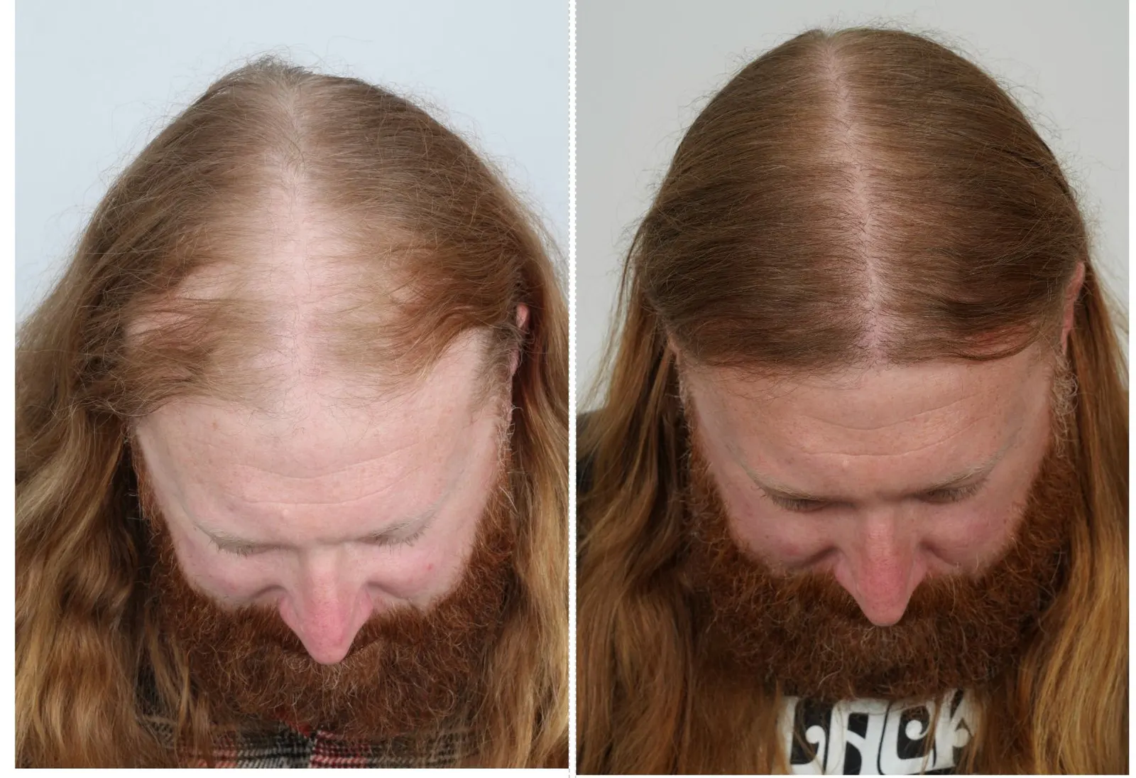 A before and after result posted to Instagram