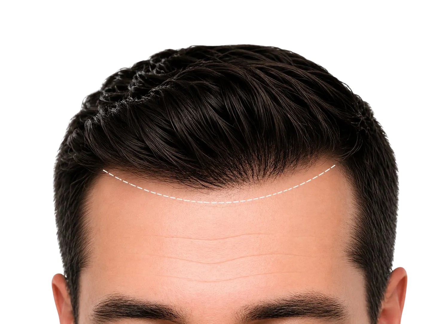 Close-up of a planned hairline marked on a patient’s scalp