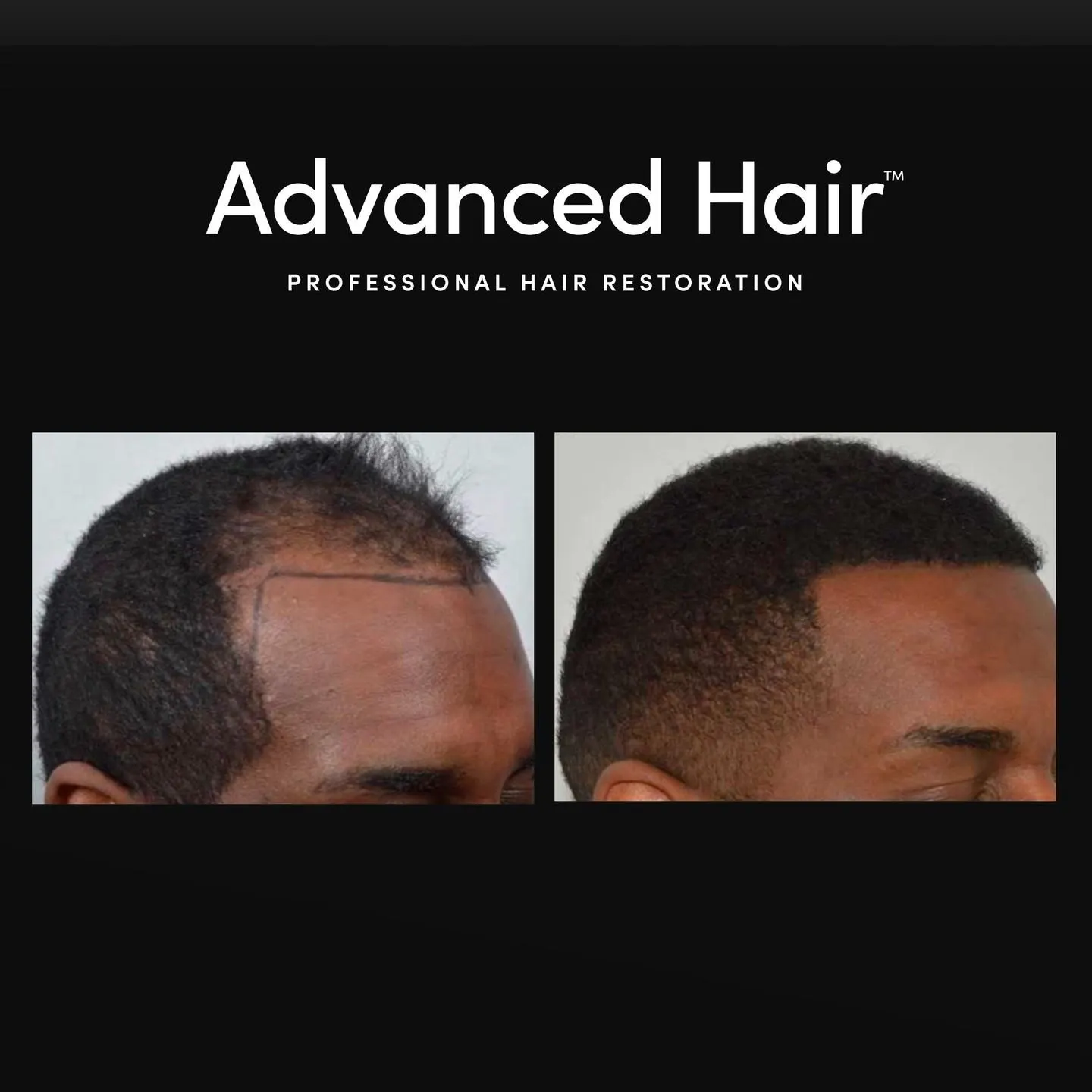 Two people standing in front of an Advanced Hair Restoration sign